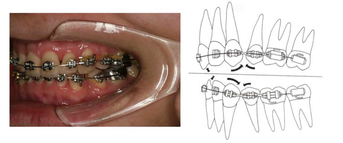 遇上不良正畸這些整牙後遺症真可能發生丨牙套深扒現場