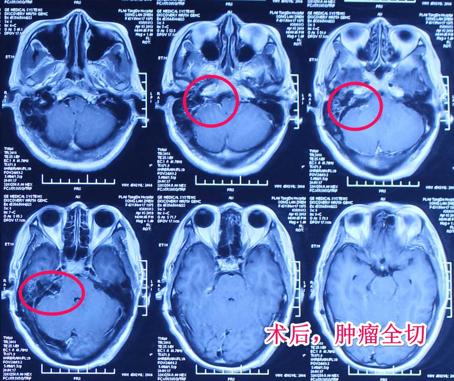 【病例分享】高难度多囊性听神经瘤病例分享 - 知乎