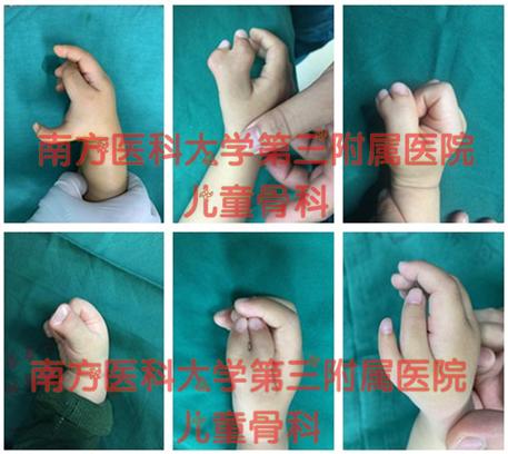 “六指神童”的六指是怎么来的? - 知乎