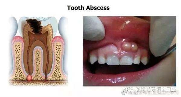牙龈出现白脓包 你以为只是发炎吗 知乎