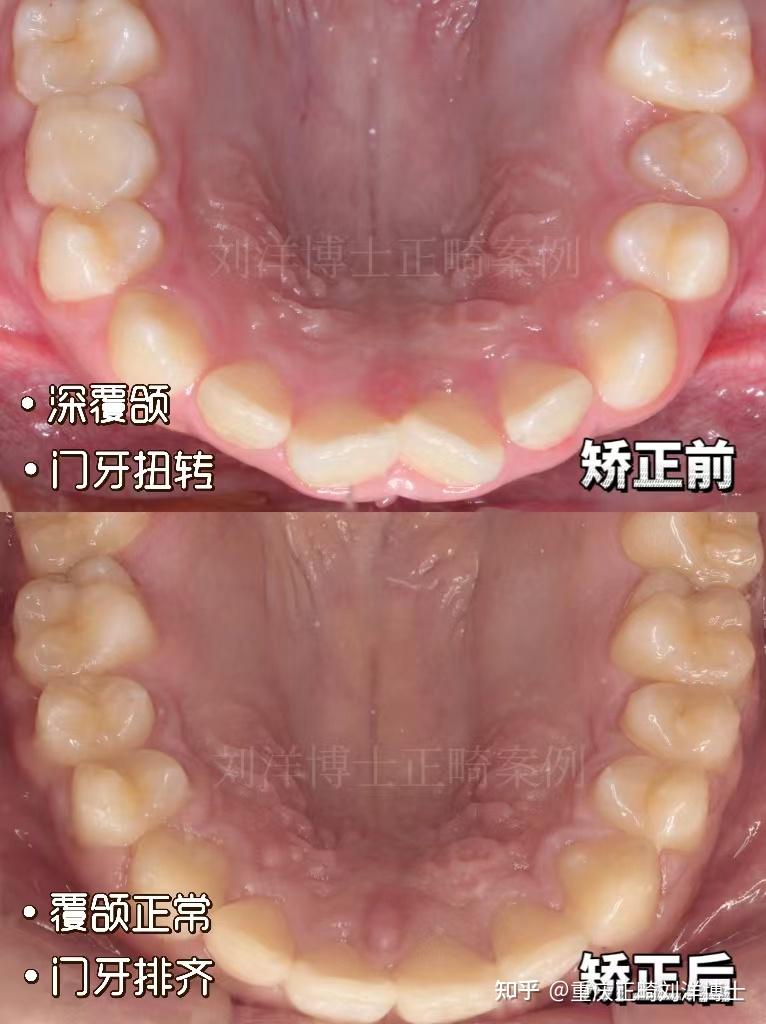 重庆牙齿矫正|重庆正畸|青少年矫正|送给16岁最美好的礼物!