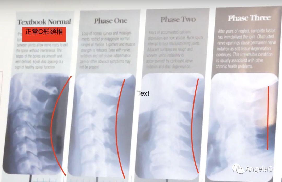 我是这个阶段),下图是从正常的颈椎(图1),下图是正常颈椎(呈现字母c的