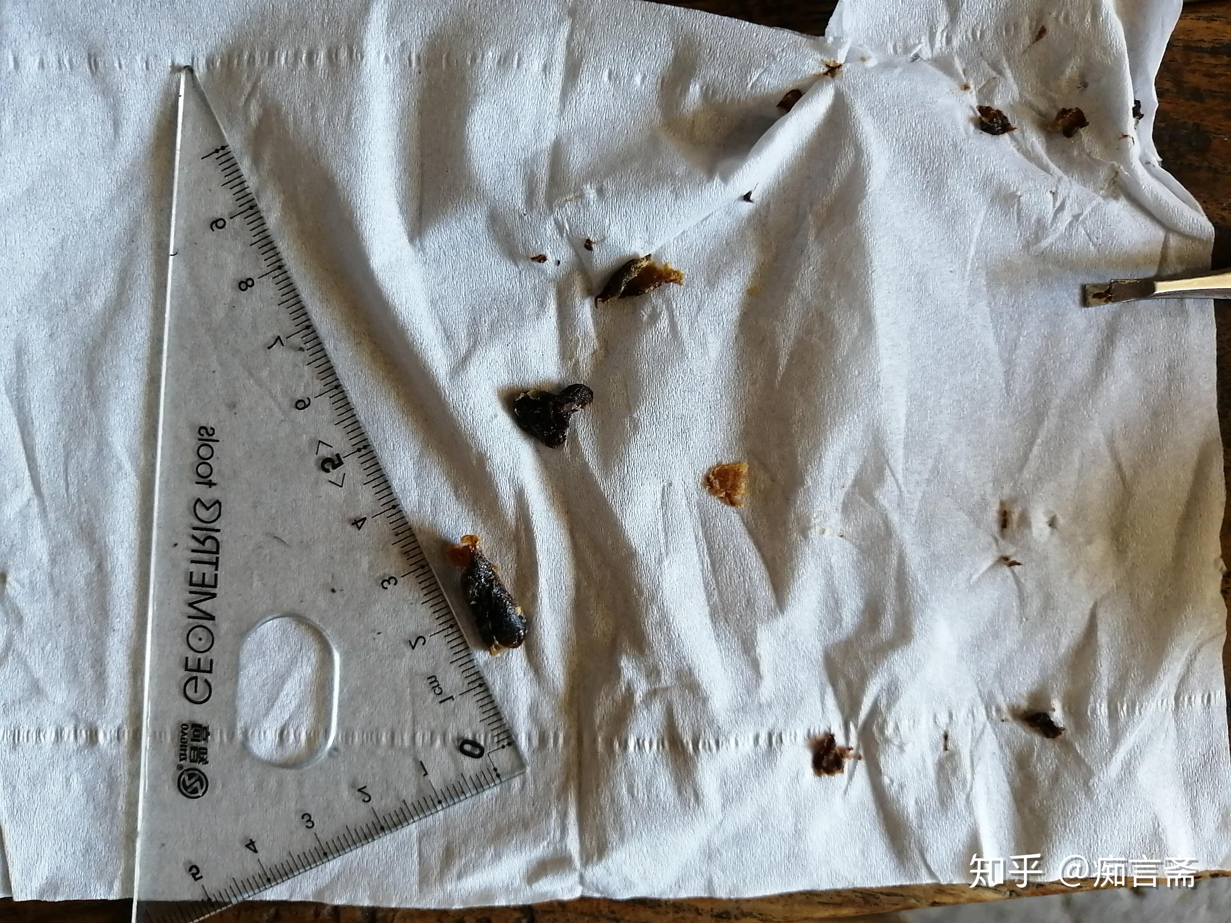 耳屎能大到什么程度?