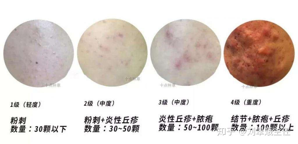 78门诊案例重度痤疮千万不要再乱用药了