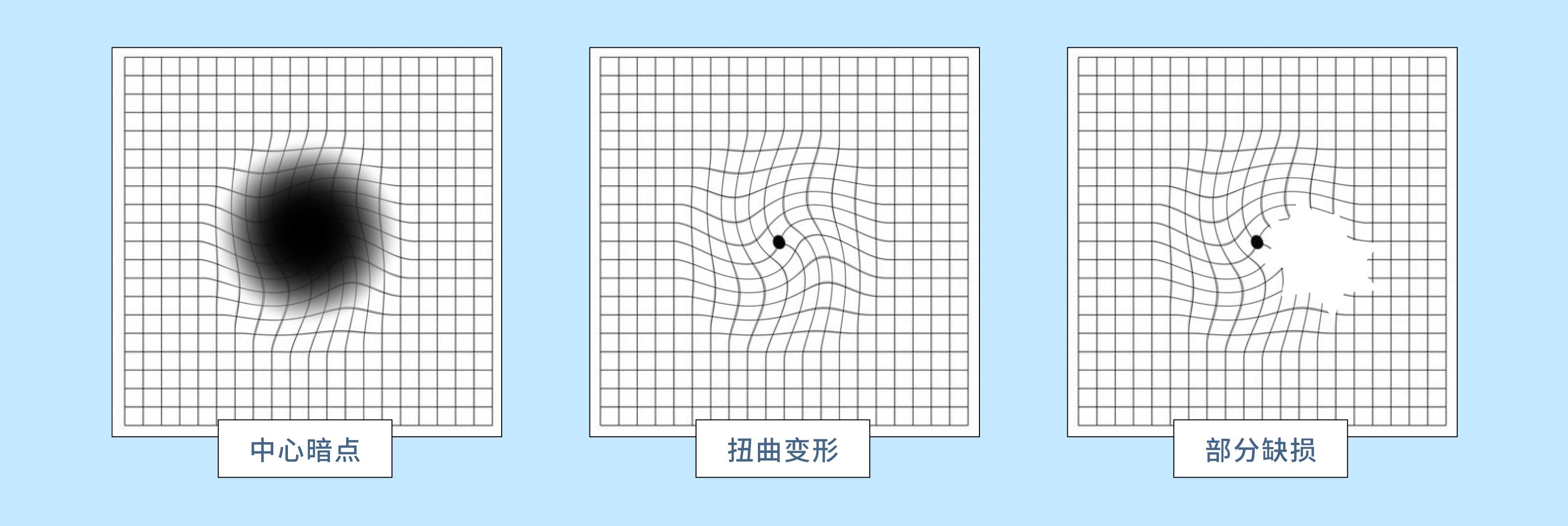 一文了解 | 老年性黄斑变性（年龄相关性黄斑变性） - 知乎