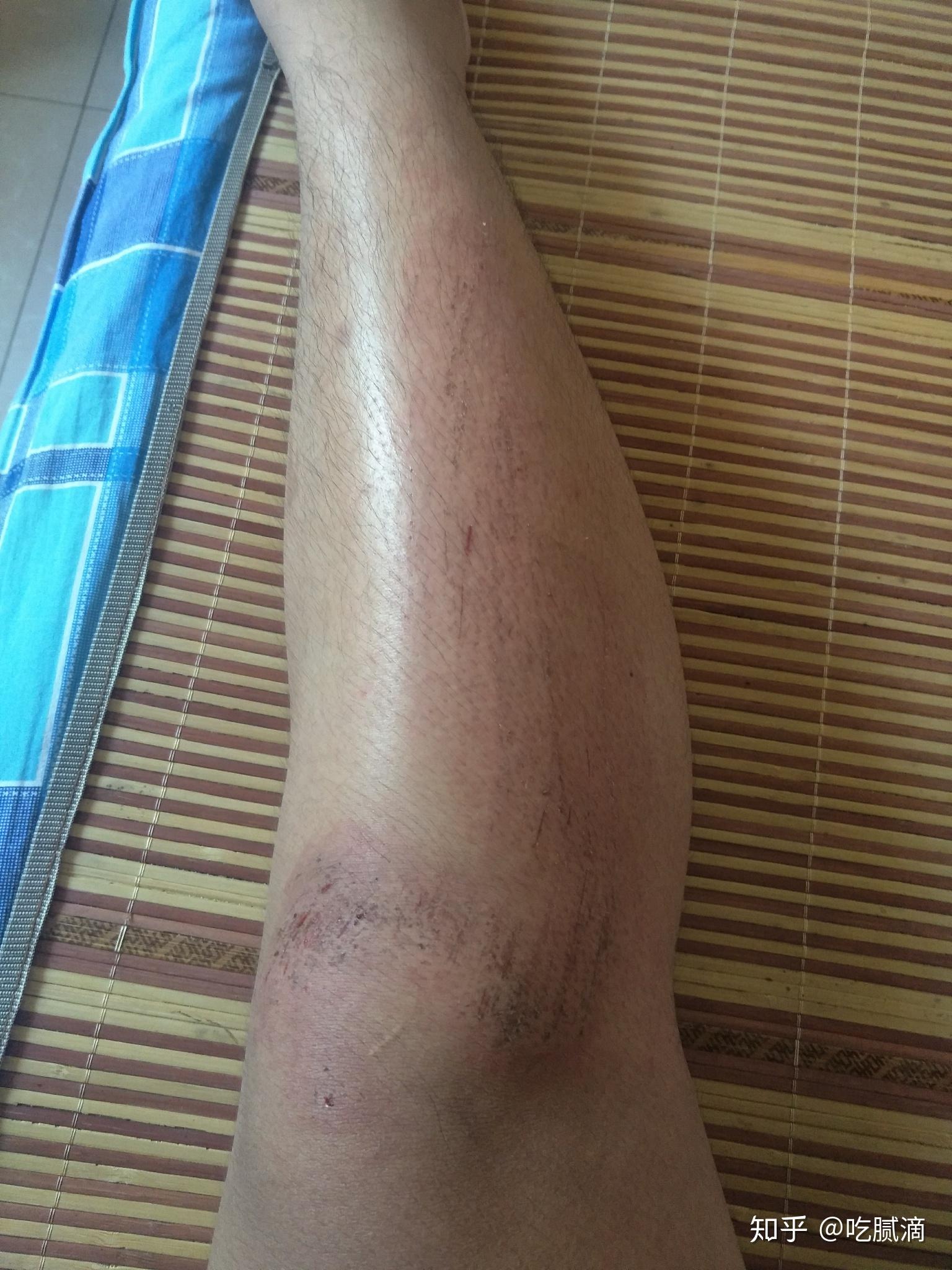 骑车摔伤腿破了会影响招飞吗