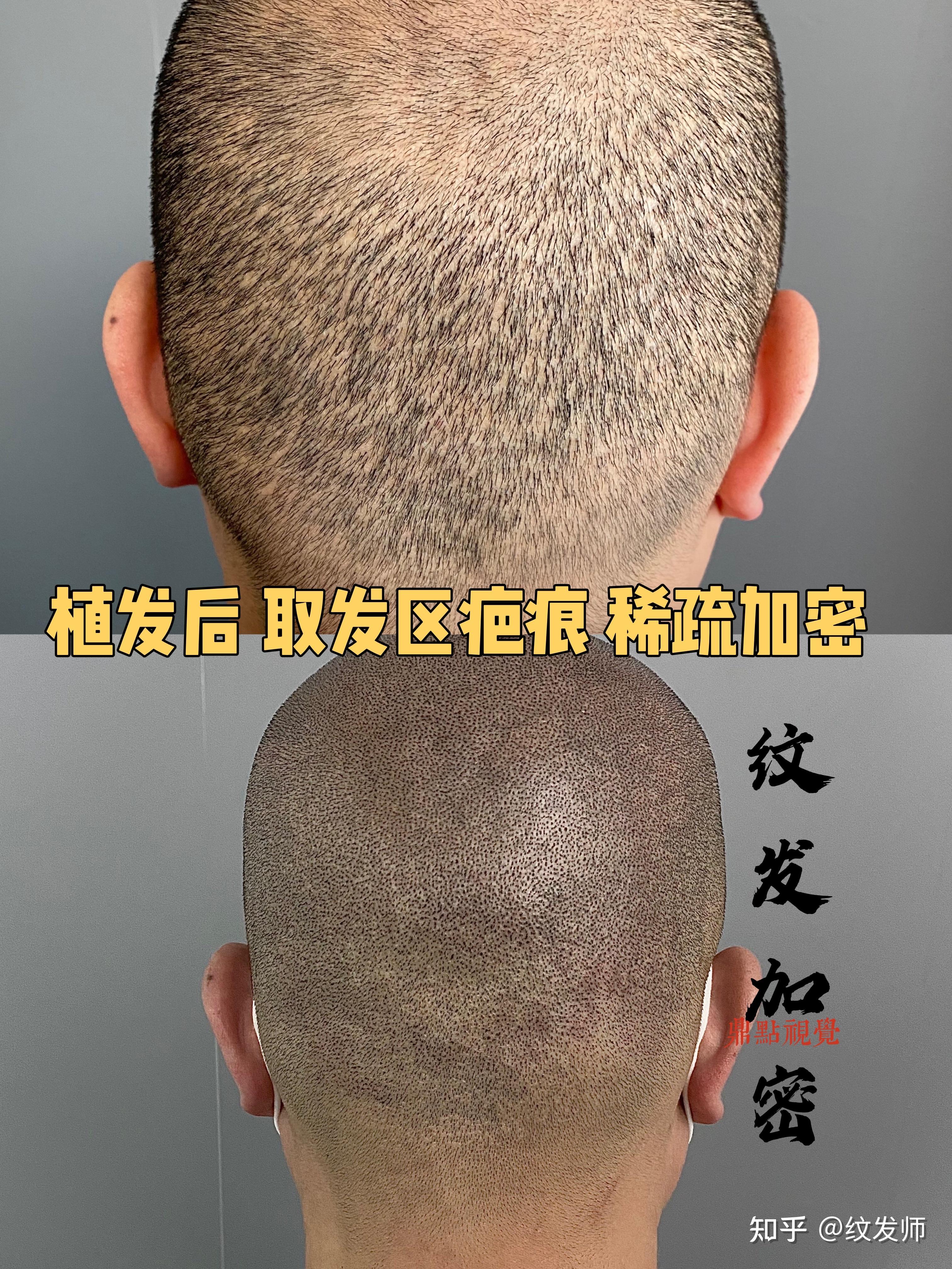 植发好还是纹发(植发和纹身哪个疼)