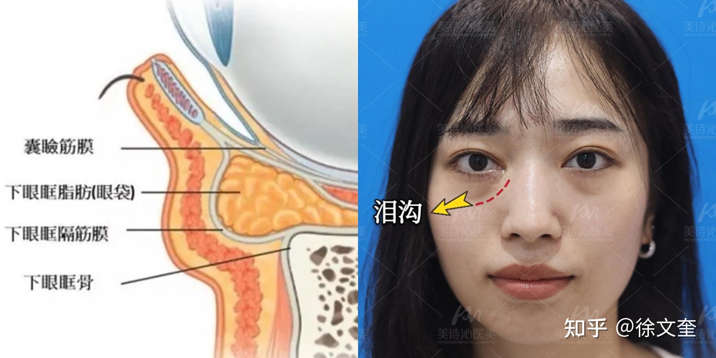 眶隔眶隔,自体脂肪,玻尿酸填充泪沟有什么区别吗?
