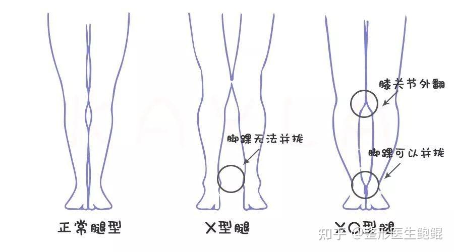 x型腿严重程度判断图图片