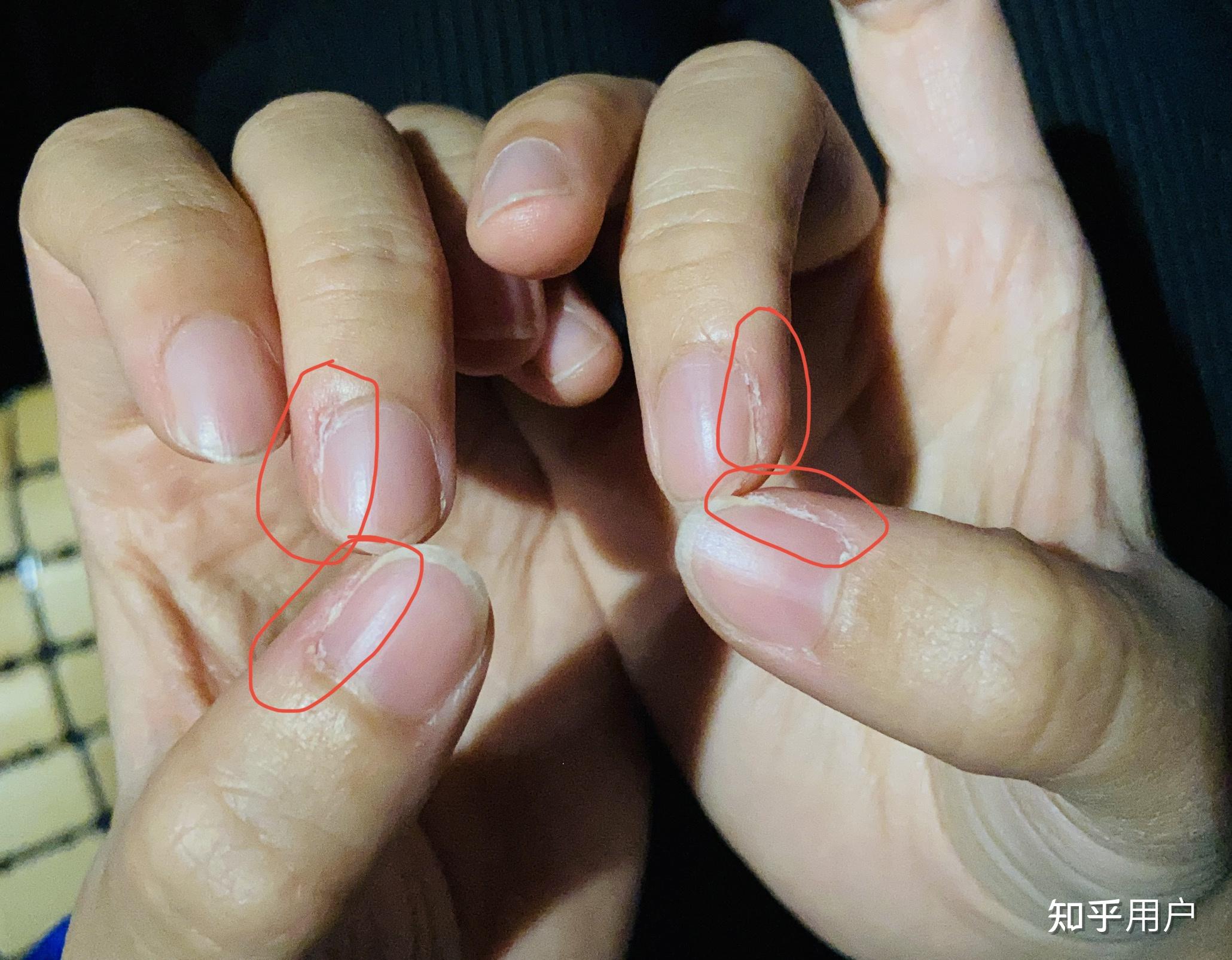 为什么双手无名指靠近小拇指的一侧指甲缝总是痒,切掉死肉后才不痒,过