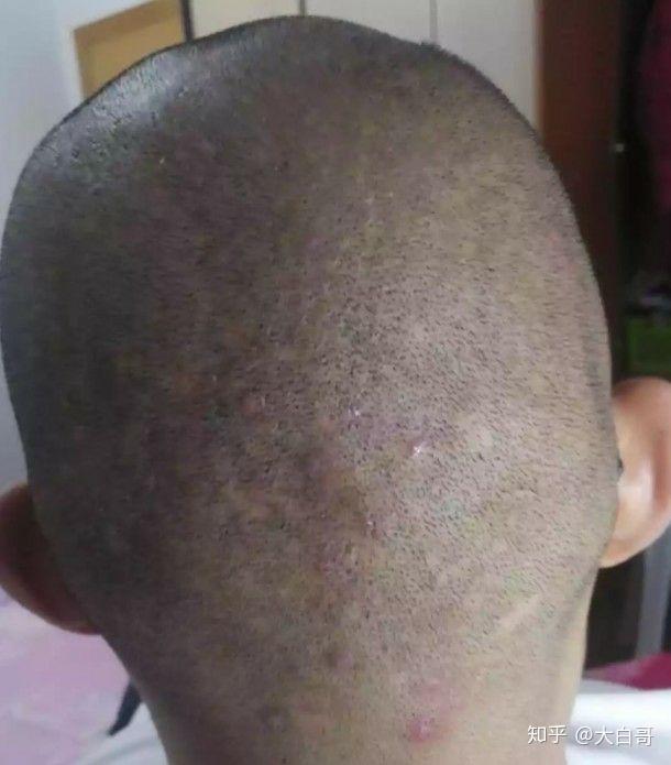 什么叫毛囊炎怎么治疗 v2-c436b9de07eb0eb92498bfe1be6e7bec_r.jpg