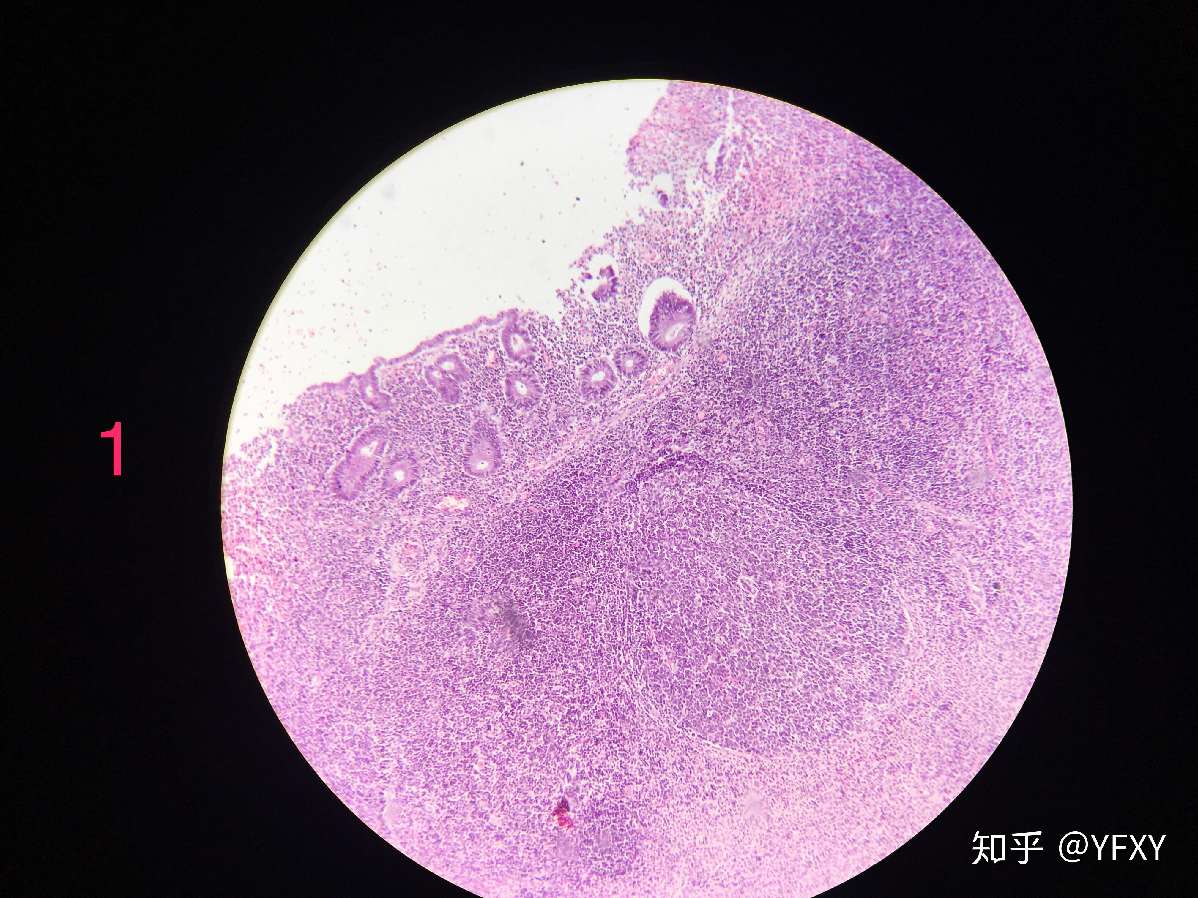 2.慢性肺淤血b.a.1.肉芽组织(仅供参考!注意多图)包含:1.肉芽组织,2.