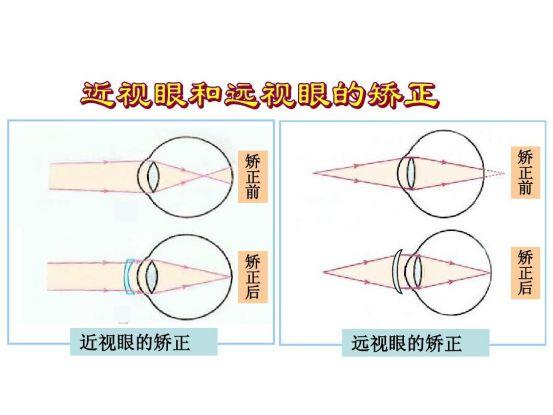 icl等,这种手术方式是做减法,它的原理是通过切削角膜组织矫正近视