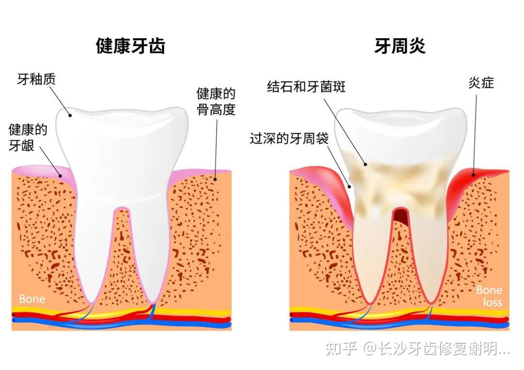 牙周炎:对我们健康施出的“温柔一刀” - 知乎