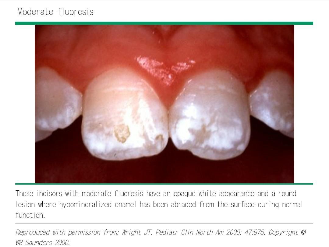 釉质钙化不全,釉质发育不全与氟斑牙的区别是什么,有图片吗? 