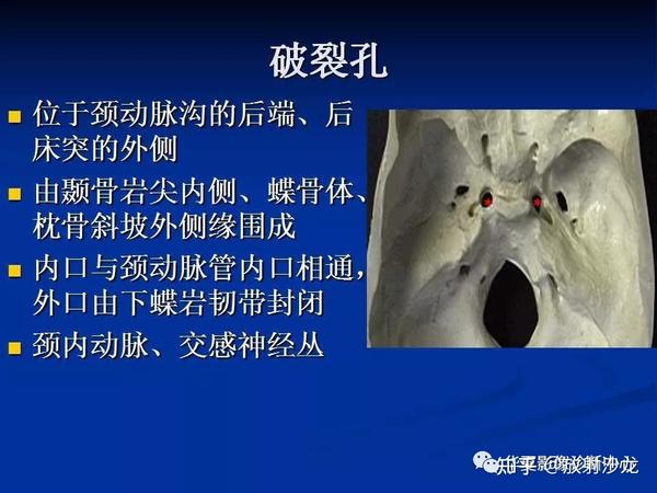 实用、详细的颅底各孔道影像解剖! - 知乎