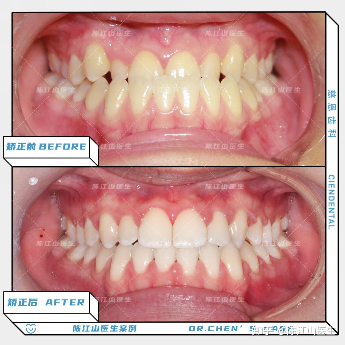 再强调一遍:虽然中线不齐确实影响健康和美观,但在正畸后保证咬合正常