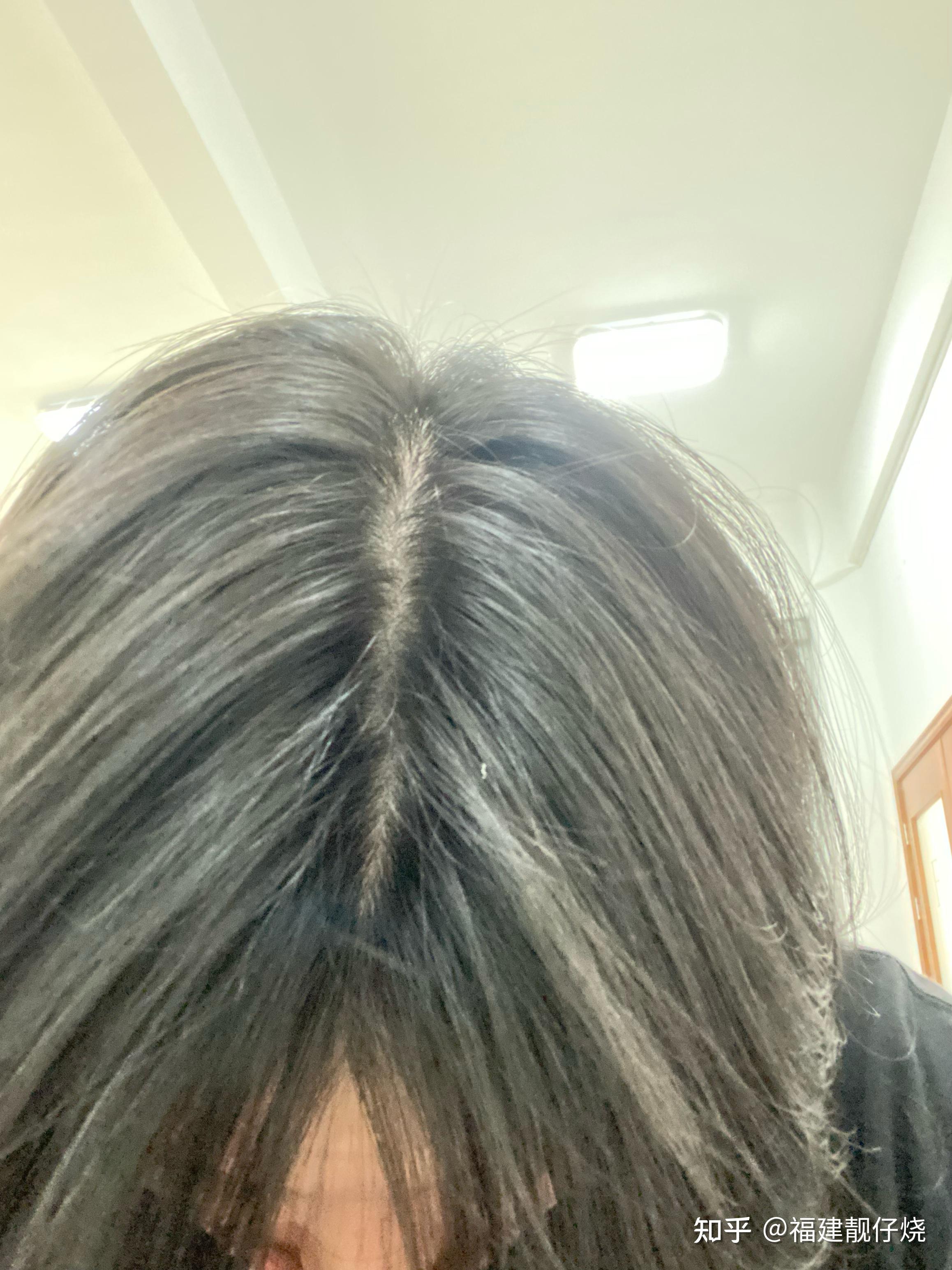 记录7年拔毛癖患者自愈日记 - 知乎