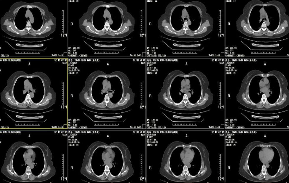 肺癌病例73岁晚期肺腺癌生存期接近4年