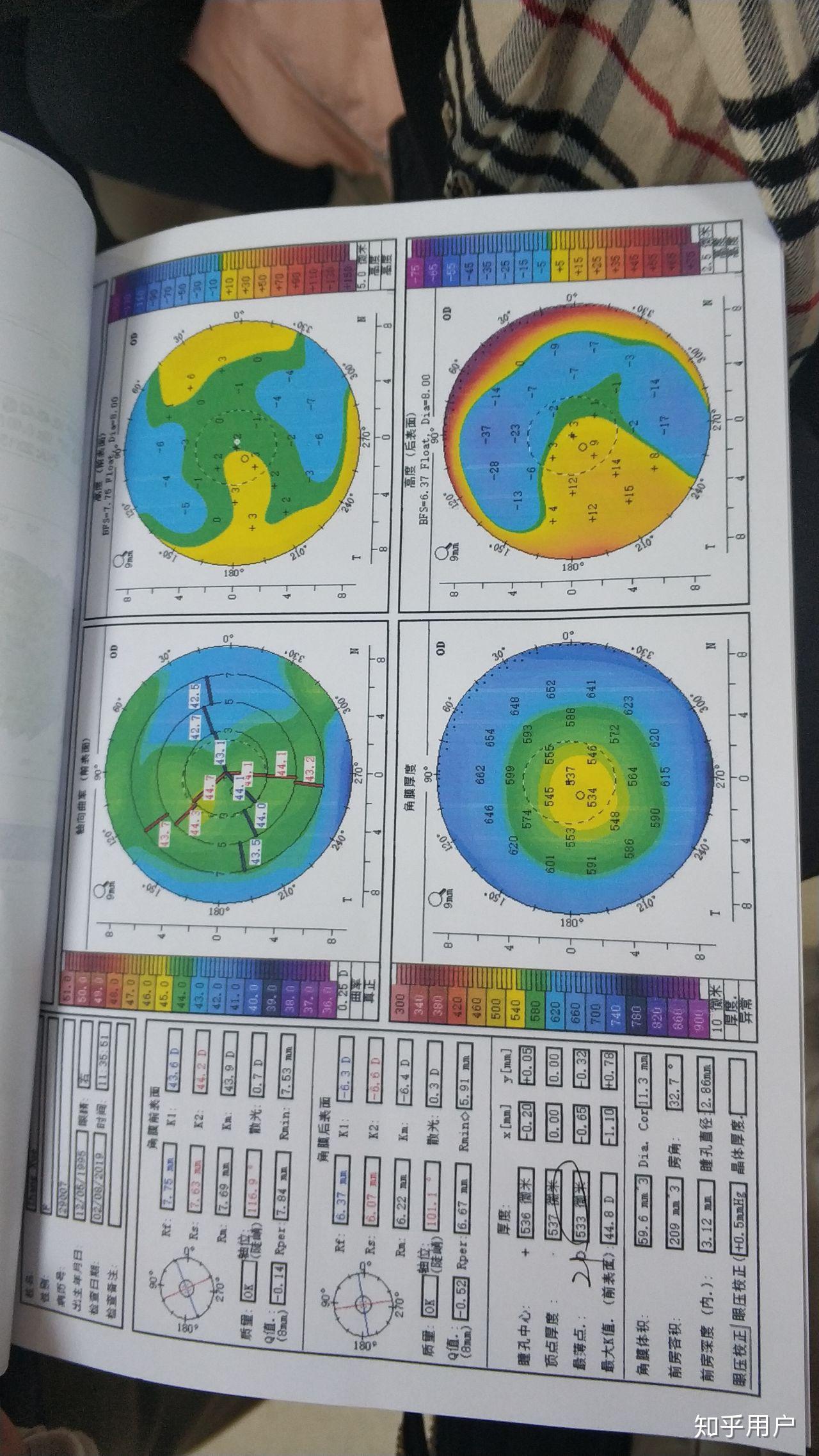 不规则散光地形图图片