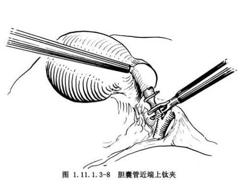 腹腔镜切除胆囊分享 知乎