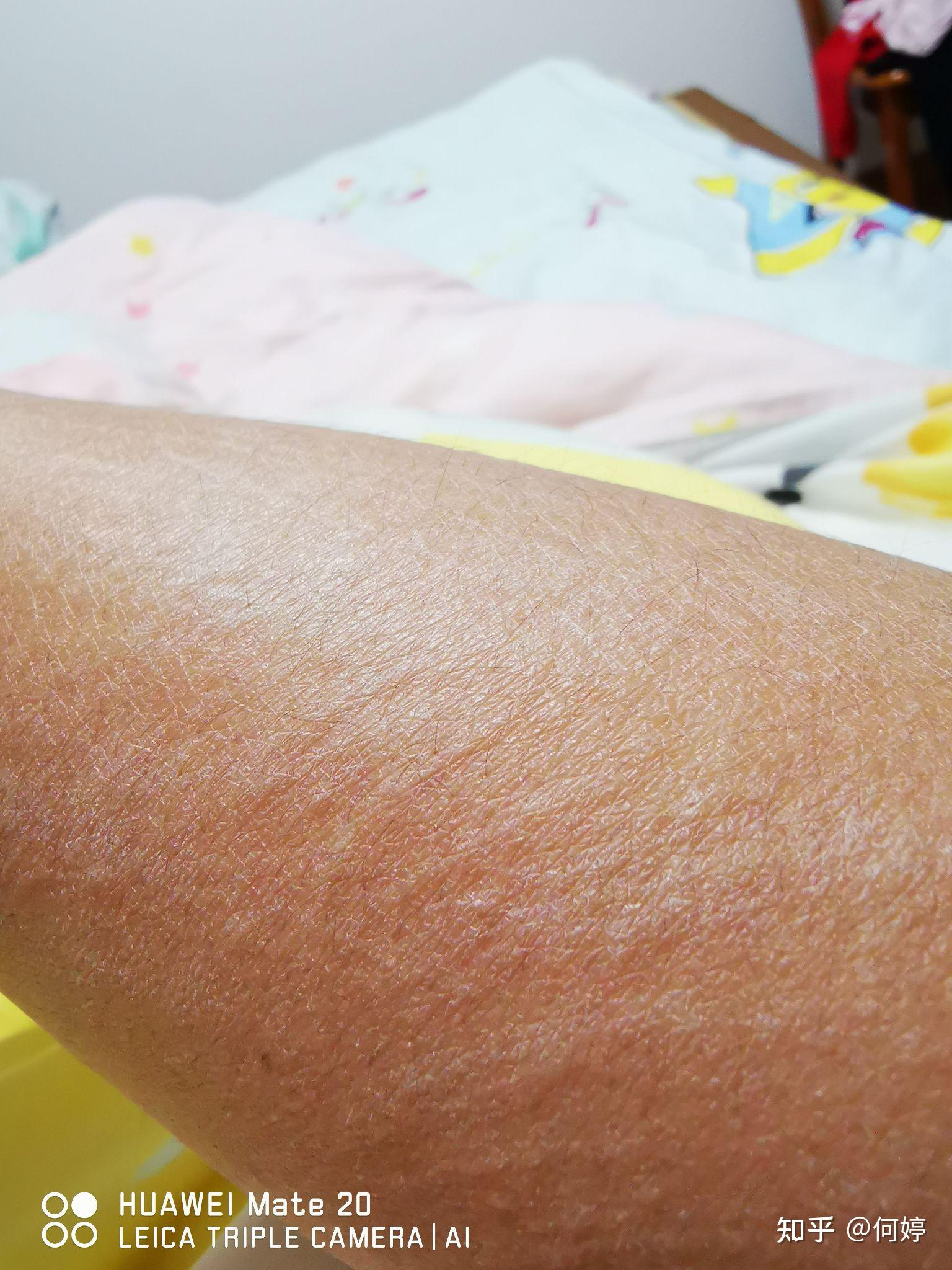 我和荨麻疹相伴的日子