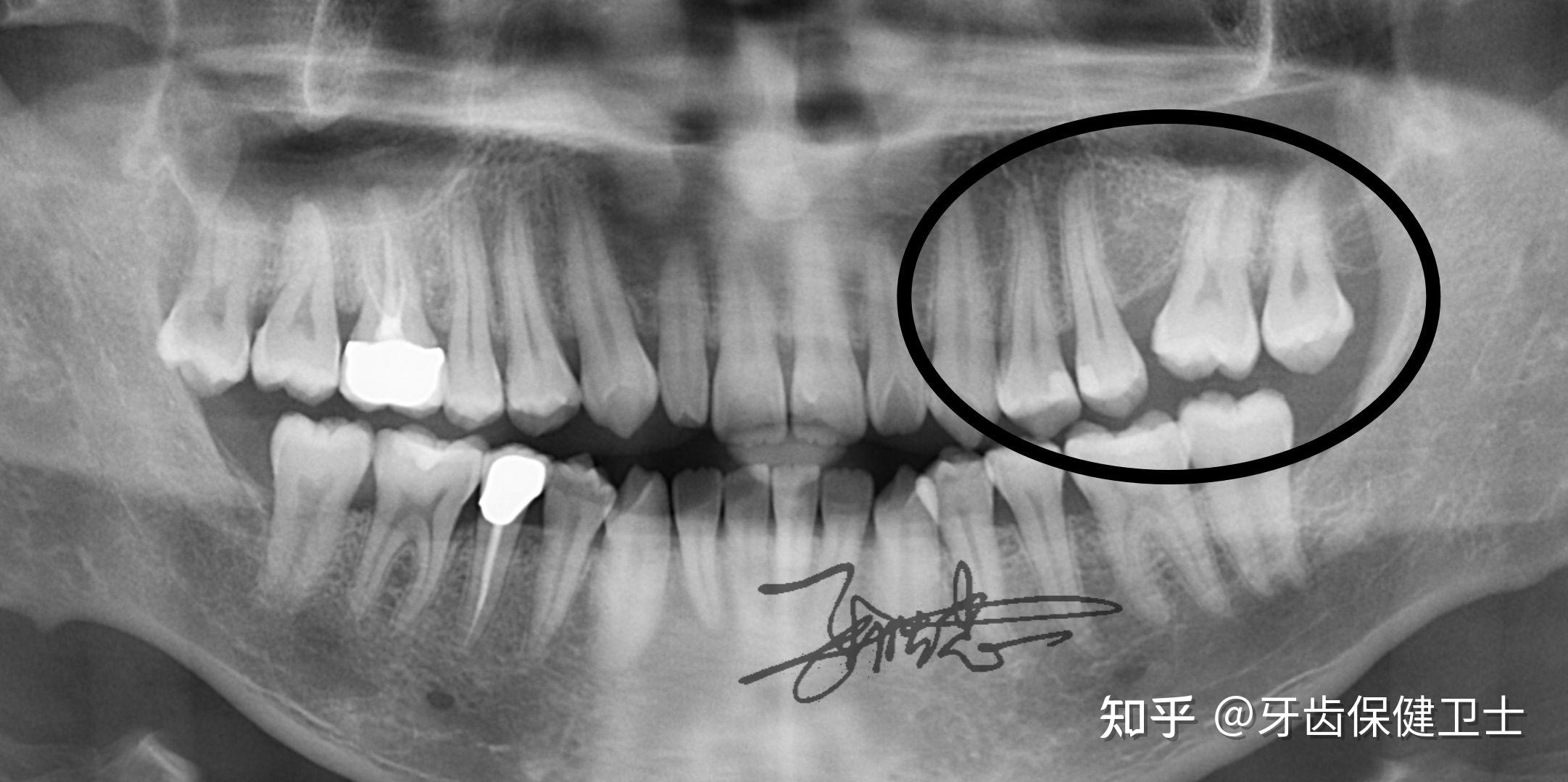 拔牙之后其他牙齿会移位吗