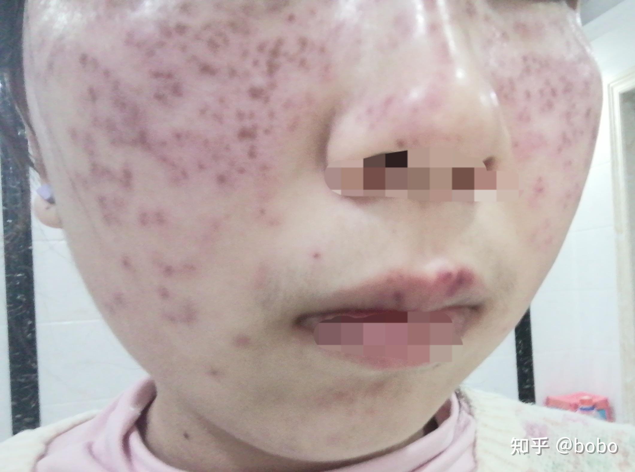 记录全过程湘雅二的激光祛斑