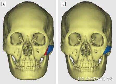 颧弓内推和颧骨降低有什么区别? - 知乎