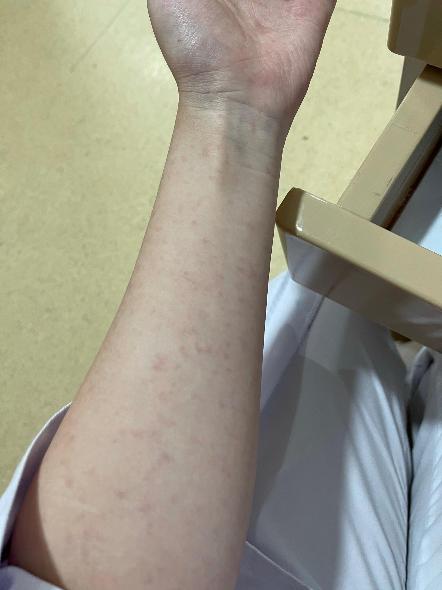 手臂突然长了红斑 不痛不痒 按了会褪色是什么情况啊?