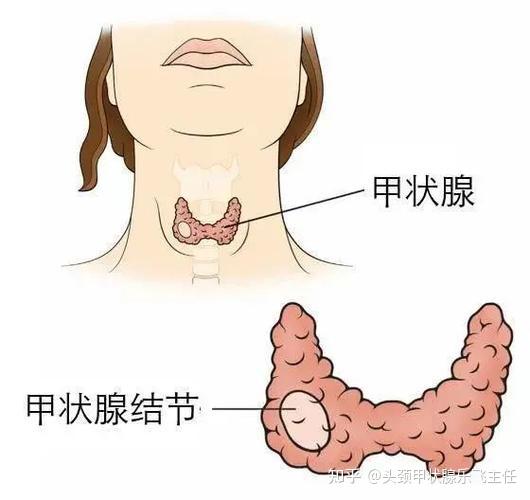 高发疾病之甲状腺癌你开始提前预防了吗