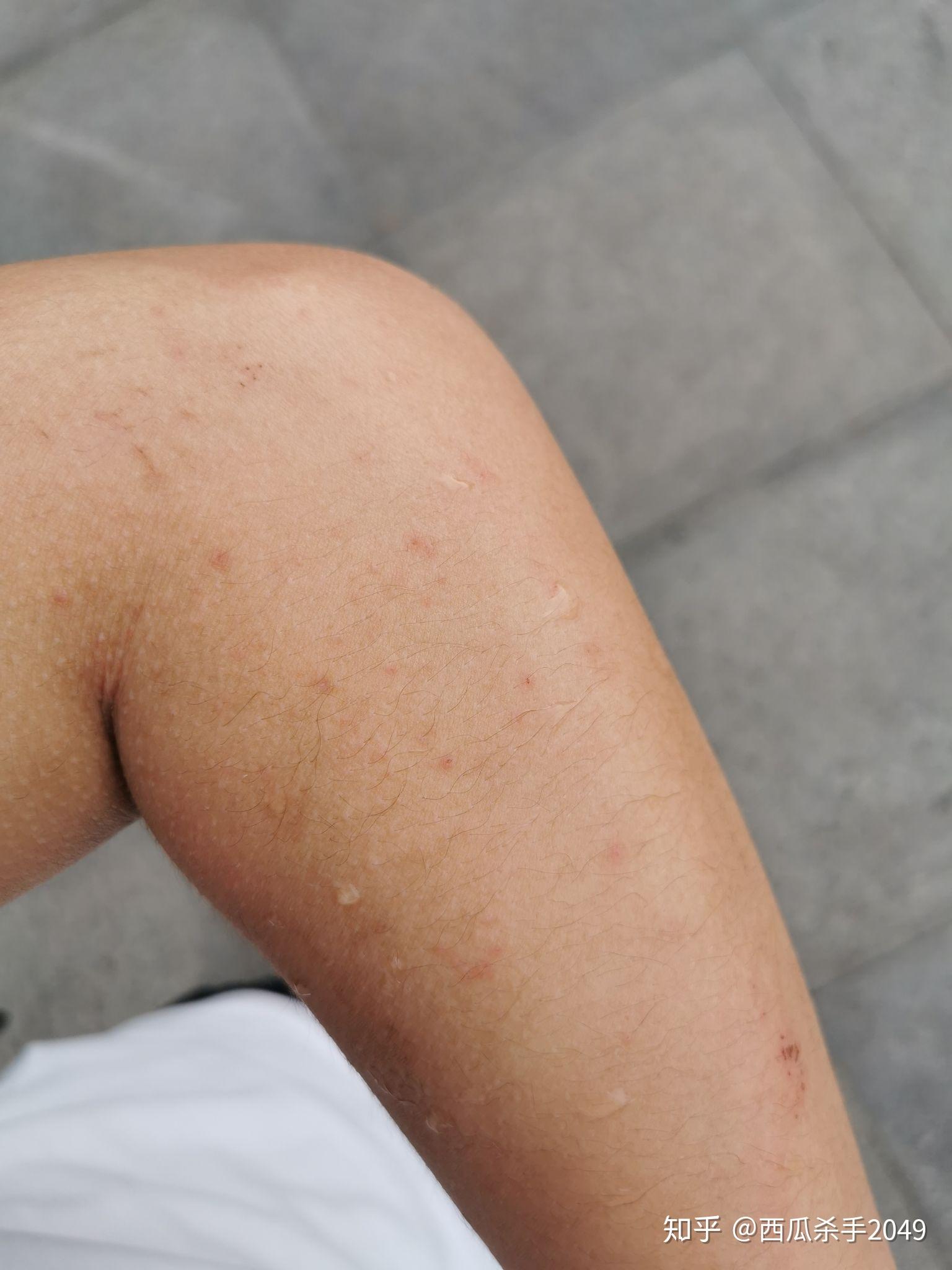 为什么会有紫外线过敏紫外线过敏如何治疗