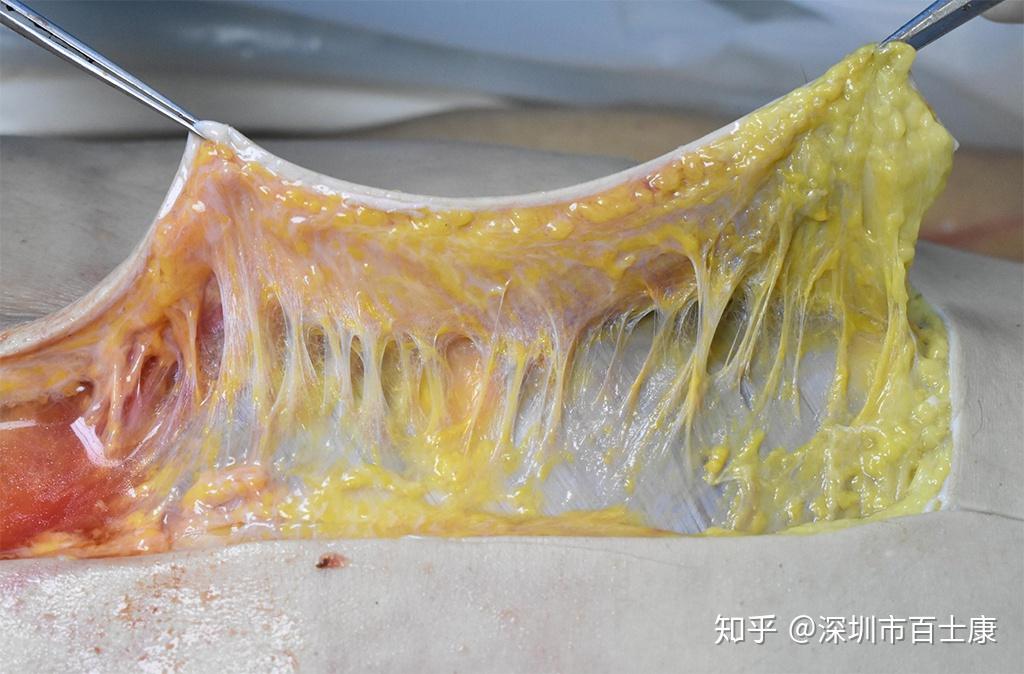 筋膜学研究与疼痛相关的临床思考