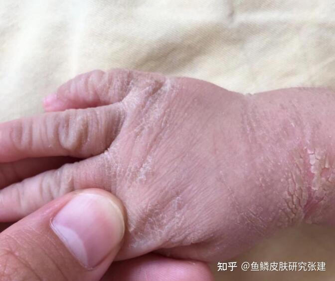 鱼鳞病遗传吗怎么区分婴儿脱皮和鱼鳞病