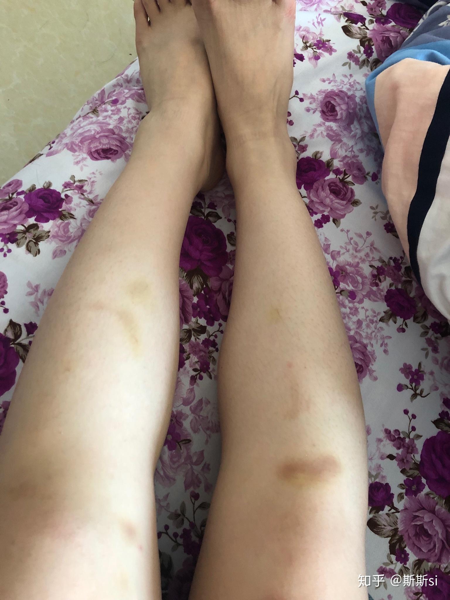女性腿部青紫块图片图片