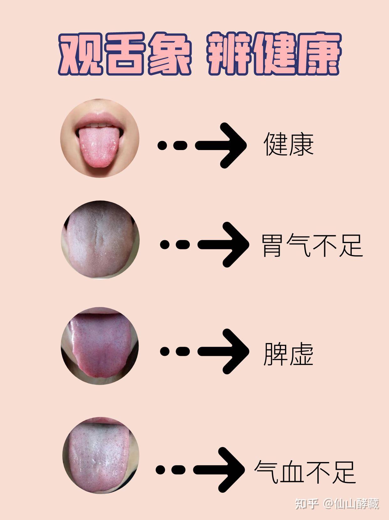 你知道看舌头就能看出这些问题吗?快来对比一下吧 - 知乎