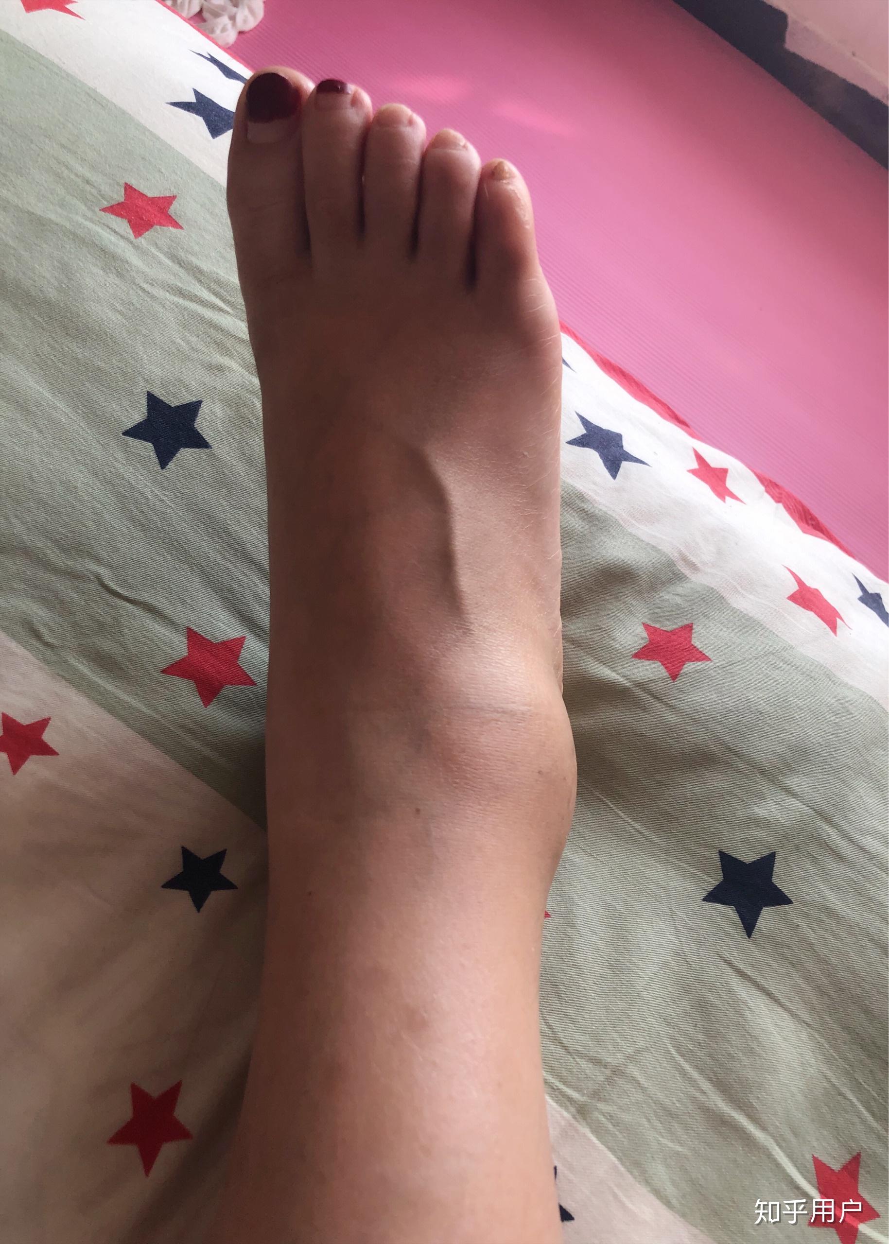 下楼梯脚崴了肿了是什么感觉