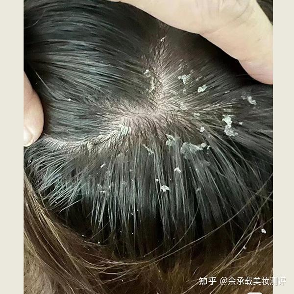 头皮发痒头皮屑多用什么洗头?洗发露清爽控油去屑止痒推荐 - 知乎