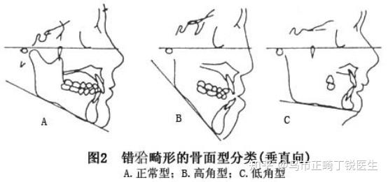 乌市牙齿矫正,整牙,正畸分享|牙齿开颌如何矫正? - 知乎