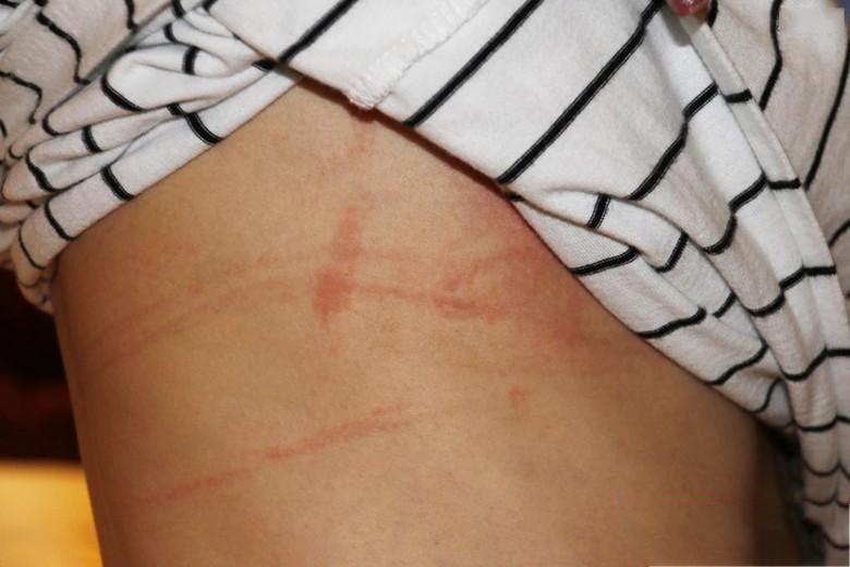 2,背部有勒痕这个就更明显了,直接说明文胸的罩杯选择过小.