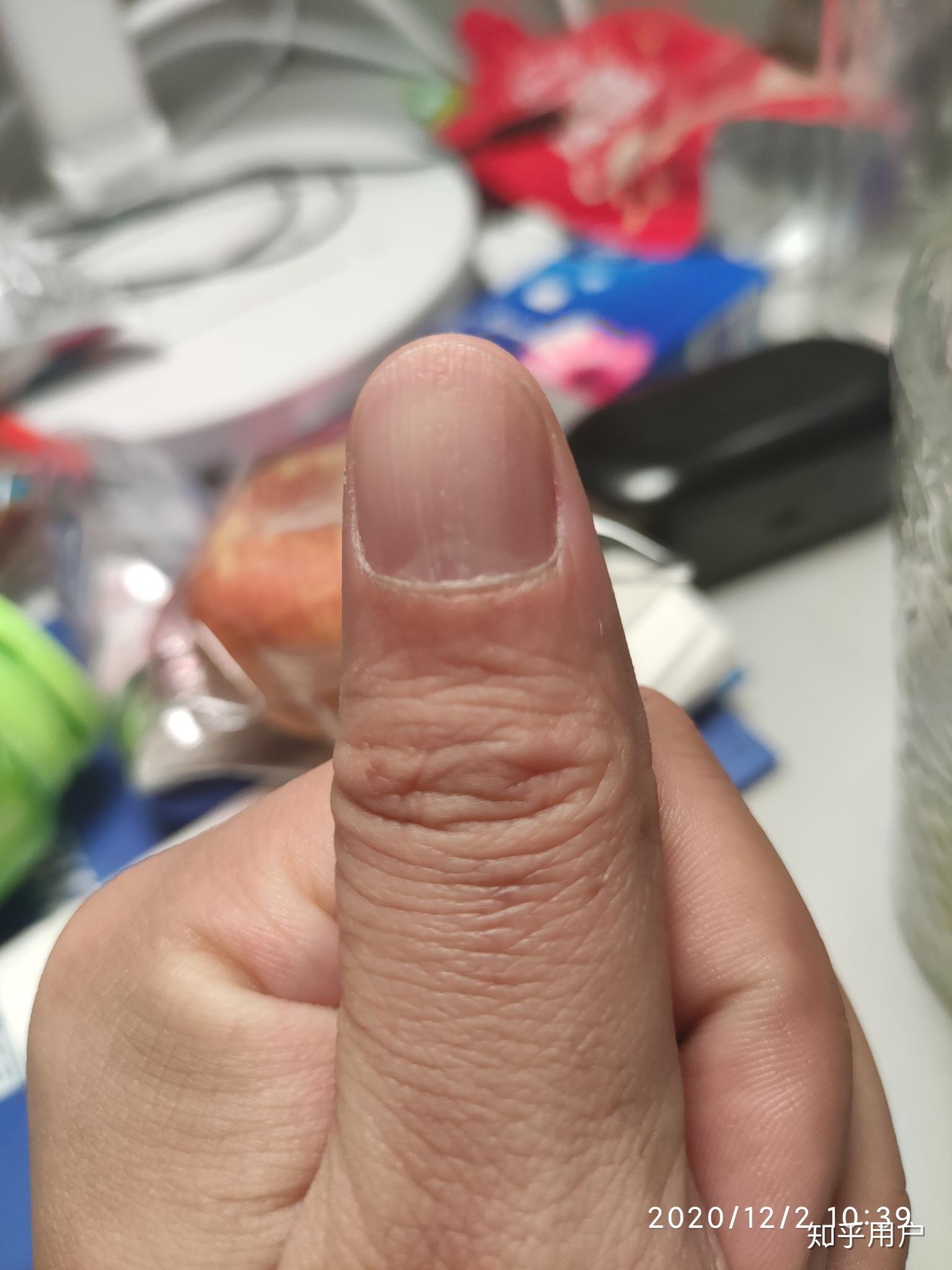 手指甲裂开了要怎么修复,治疗呢? 
