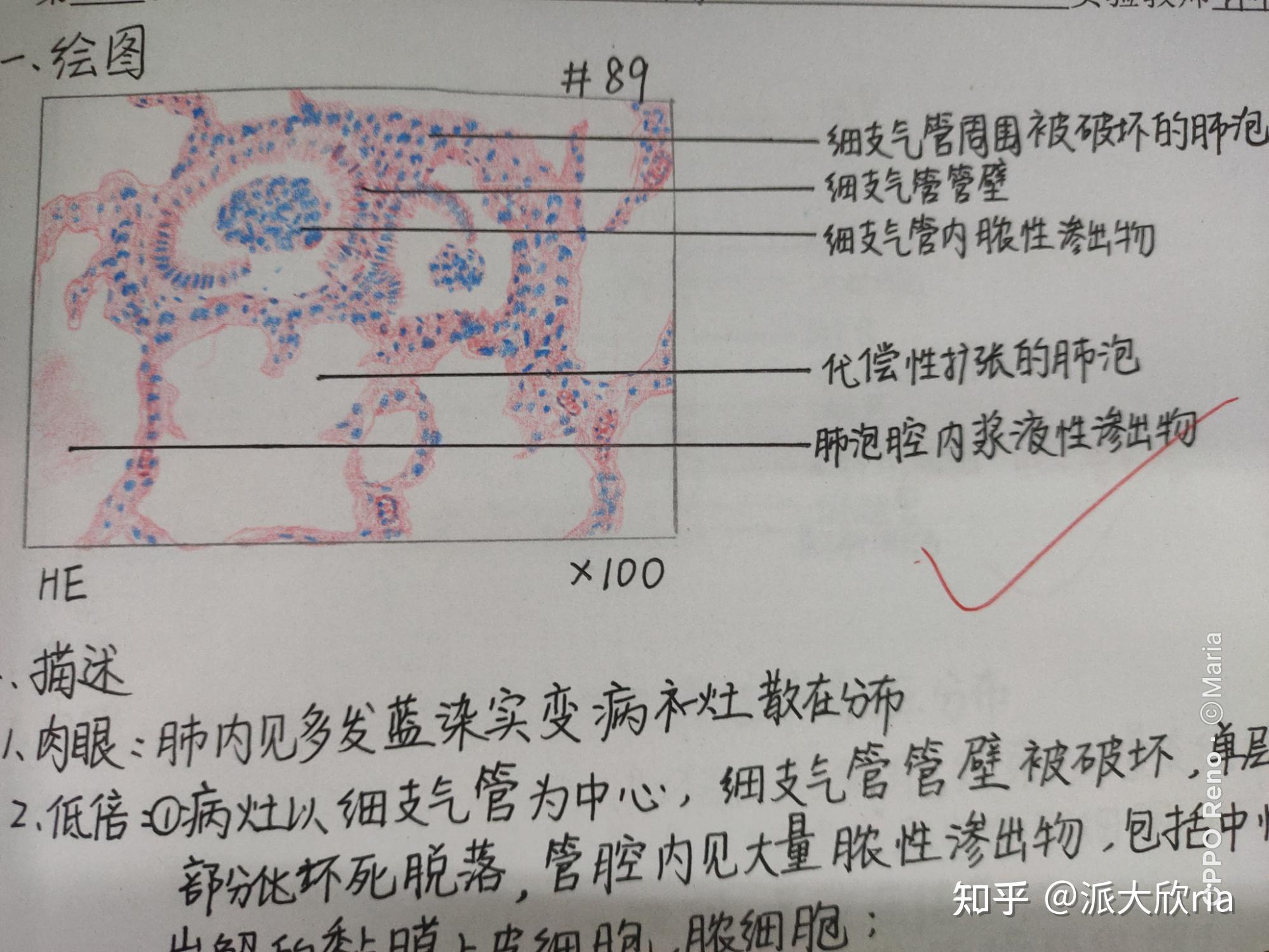 肺结核的红蓝铅笔图图片
