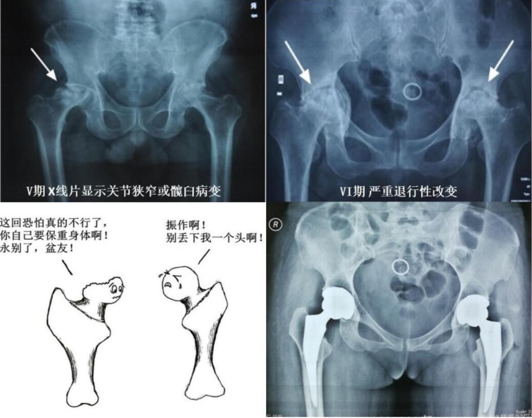 股骨头坏死关节置换（二）-双侧同期置换稳定的技术发挥 - 微医（挂号网）