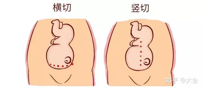 顺产侧切和剖腹产都是"挨一刀",哪个伤害小?