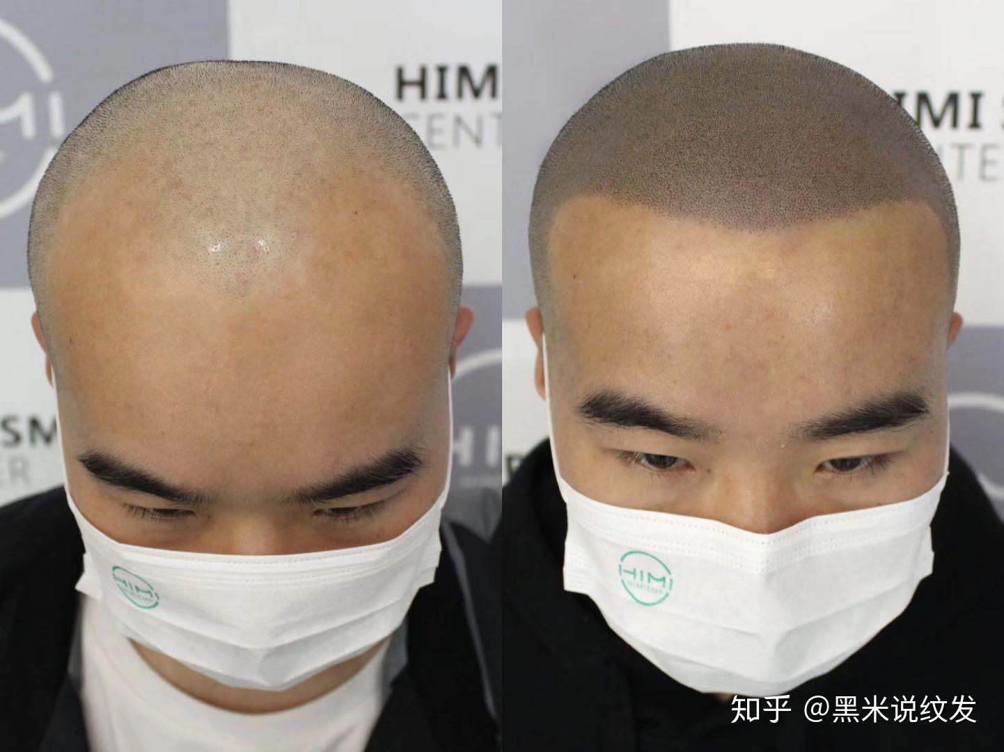 纹发是不是只能留光头？3D纹发能做的比你想象中还多 - 知乎