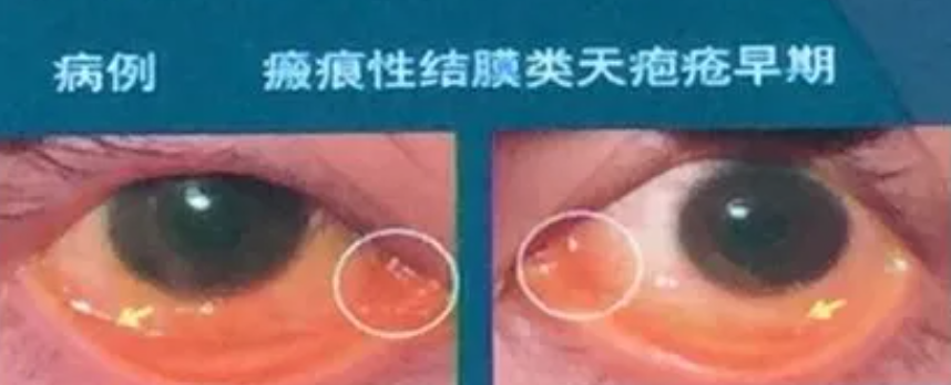 眼類天疱瘡