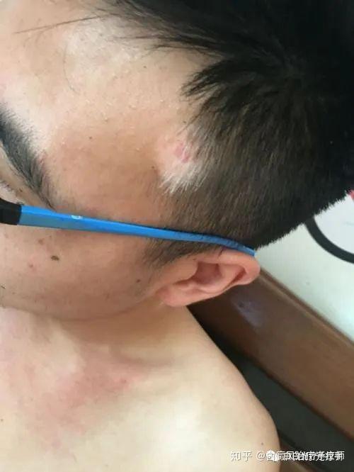 晕痣的形成与治疗