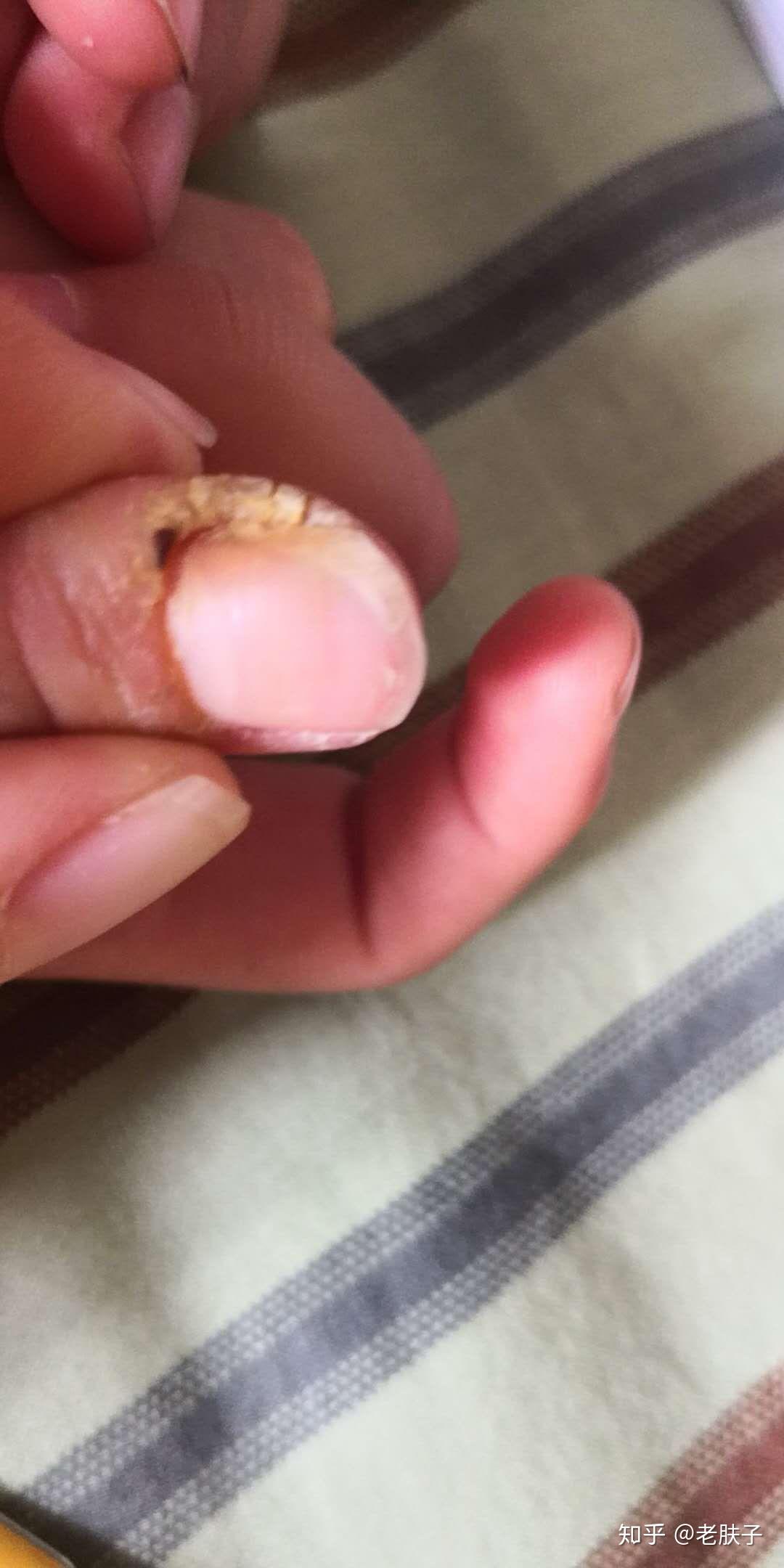 甲周疣怎么办 - 知乎