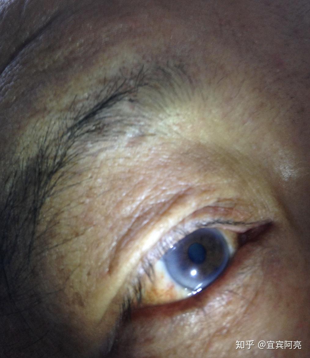 每只眼睛大概检查2-3分钟,时间不可过长,因为长时间的光照会引起眼睛