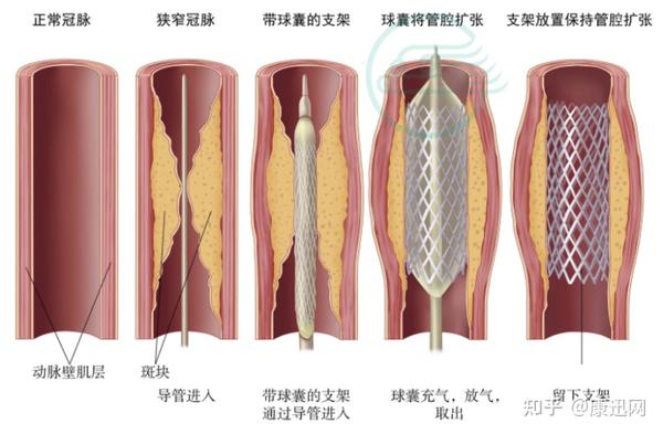 聊聊心脏支架的那些事儿 - 知乎